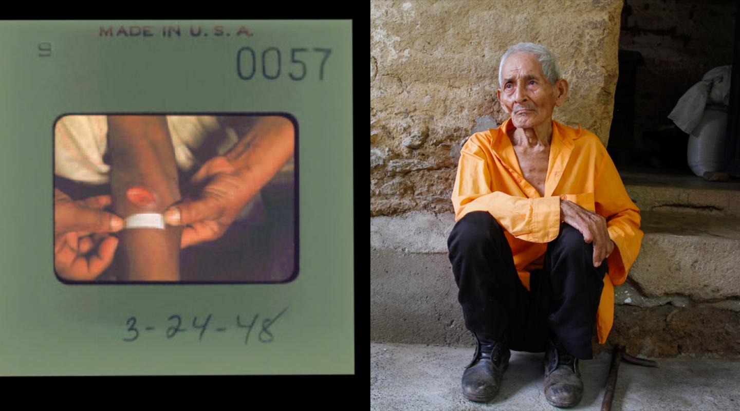 Left: The syphilitic chancre of a female psychiatric subject who was exposed to syphilis twice and after some treatment passed away. Right: Lawsuit plaintiff Frederico Ramos, age 91, sits on the porch of his son's house in San Agustín Acasaguastlán, Guatemala, Sept. 3, 2016. 