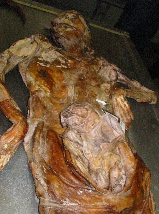 Remains of a pregnant Bosniak (Bosnian Muslim)…