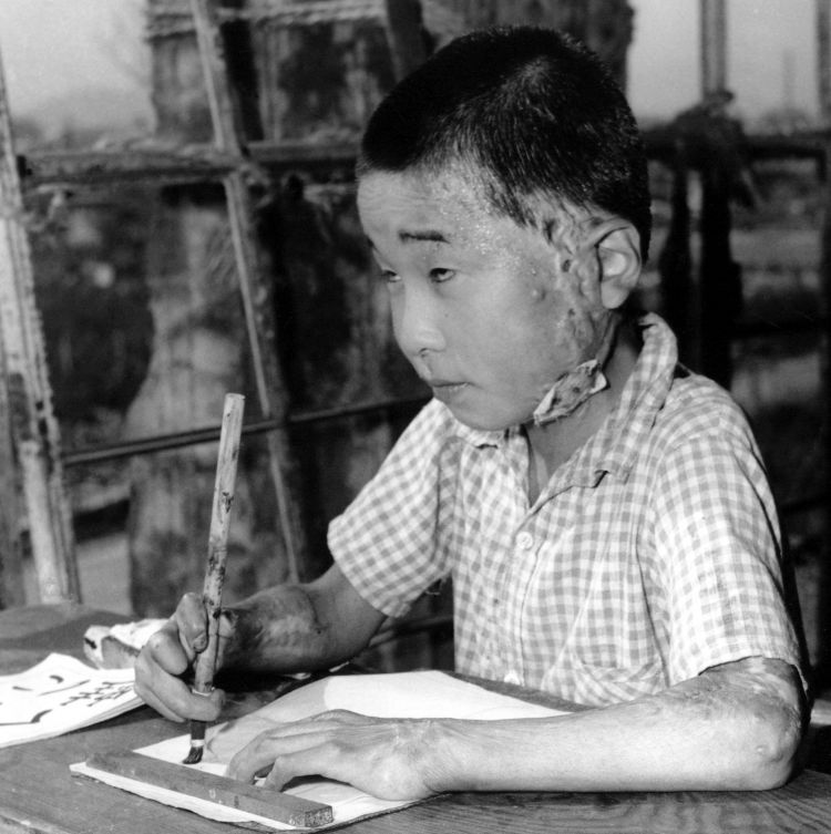 A young school child pictured in 1946 affected by the Hiroshima Atomic Bombings

